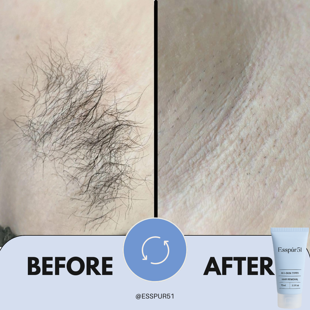 SET C - Removal Cream x3 + Aloe Vera x2